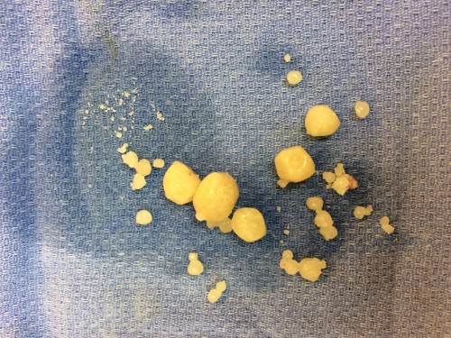 what baldder stones look like