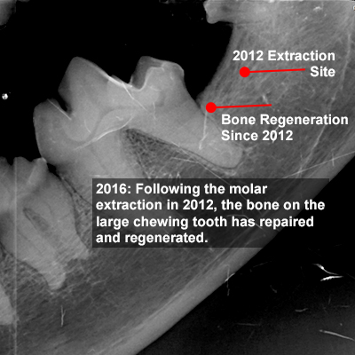 Radiograph from 2016 showing repair and bone regeneration of the tooth adjacent to the extraction site